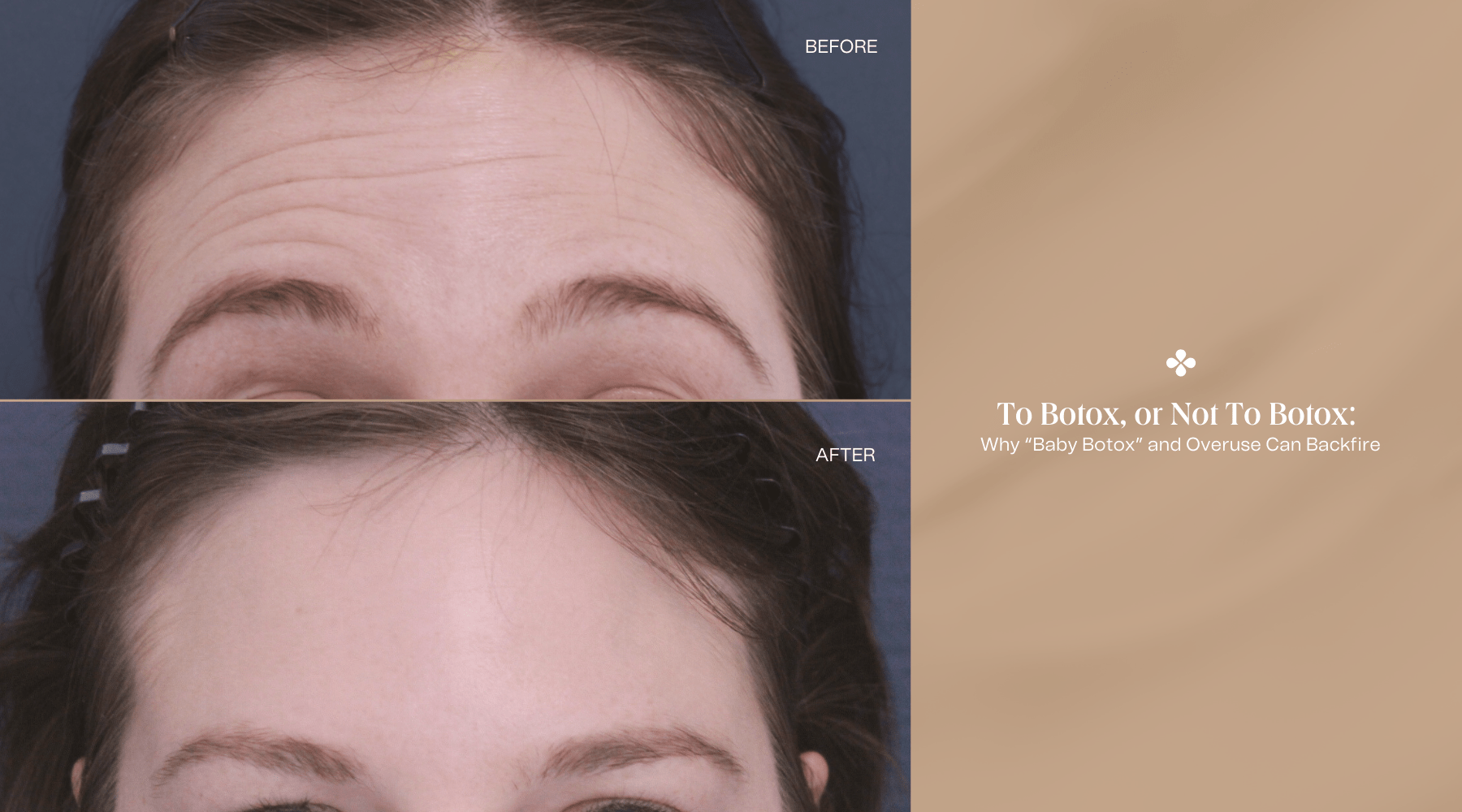 To Botox, or Not to Botox: Why “Baby Botox” and Overuse Can Backfire ...